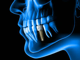 Maximize Your Investment: Learn How Long Dental Implants Last